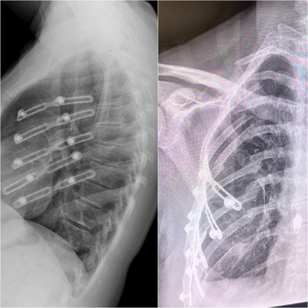 X-ray images show the innovative RibFix Advantage system in place